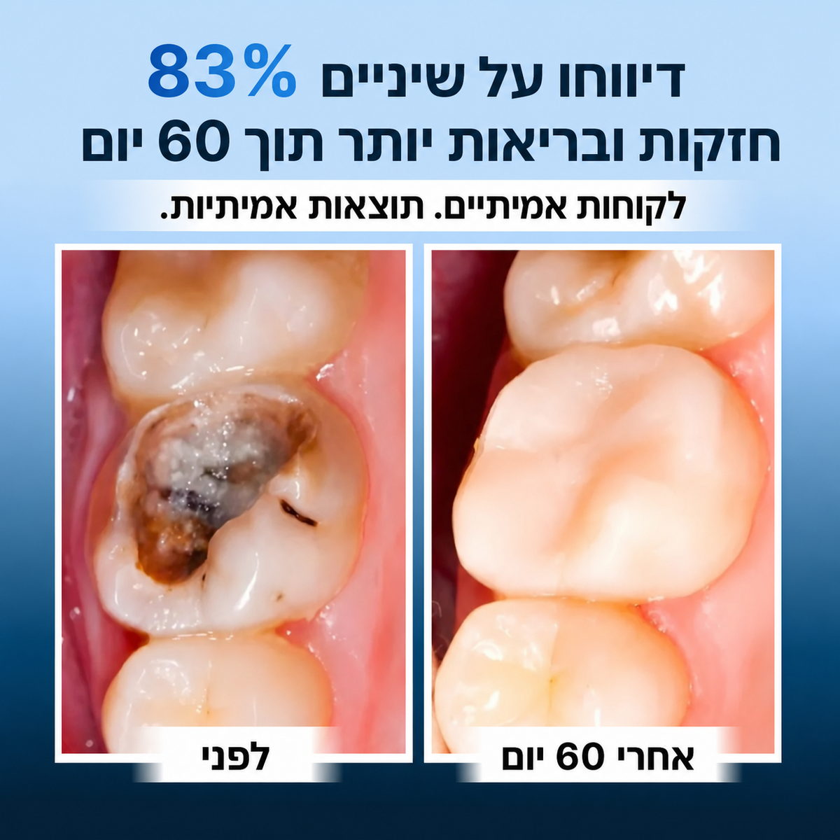Dentora- פתרון מתקדם לחיזוק ושיקום השיניים